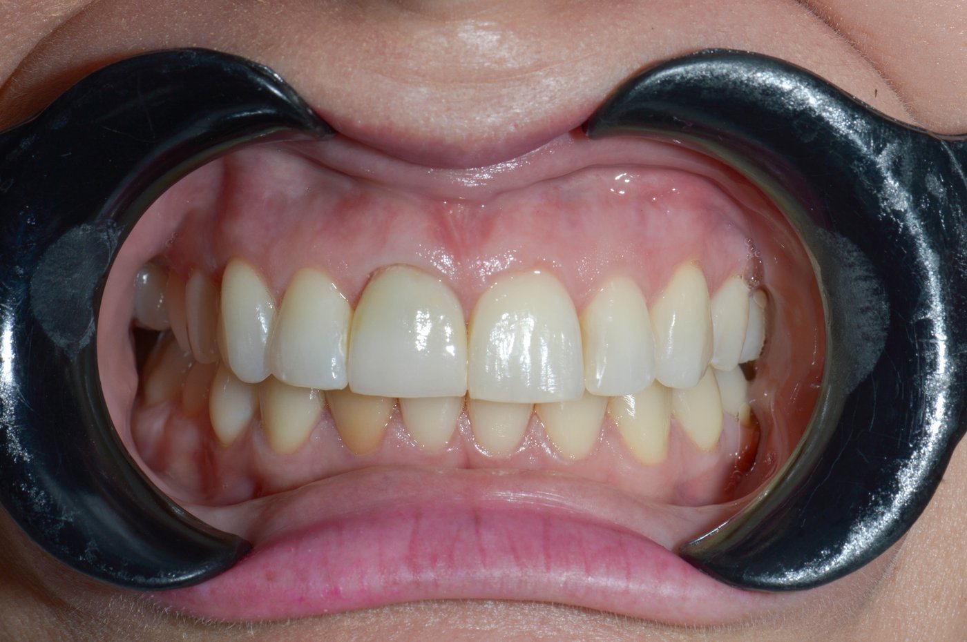 Caso de implante dentário