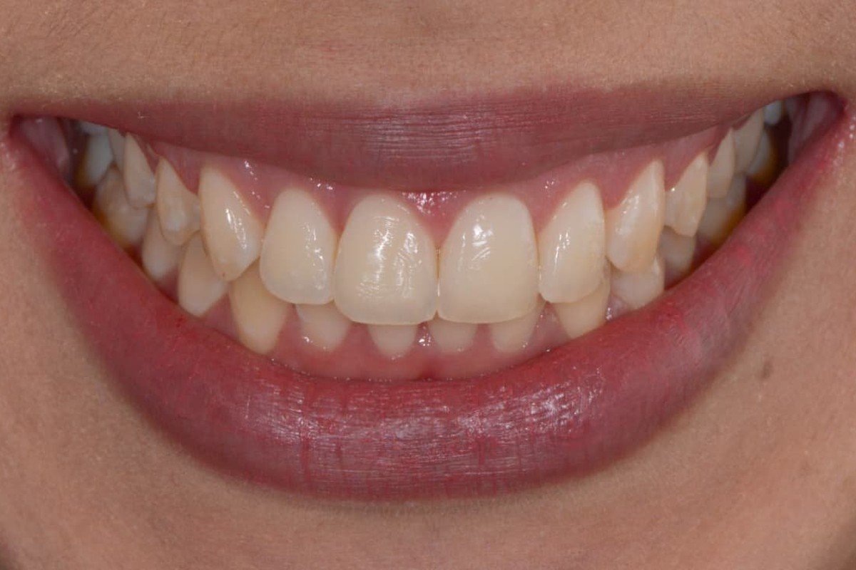 Caso real de tratamento periodontal | Dr. Wiler Monteiro
