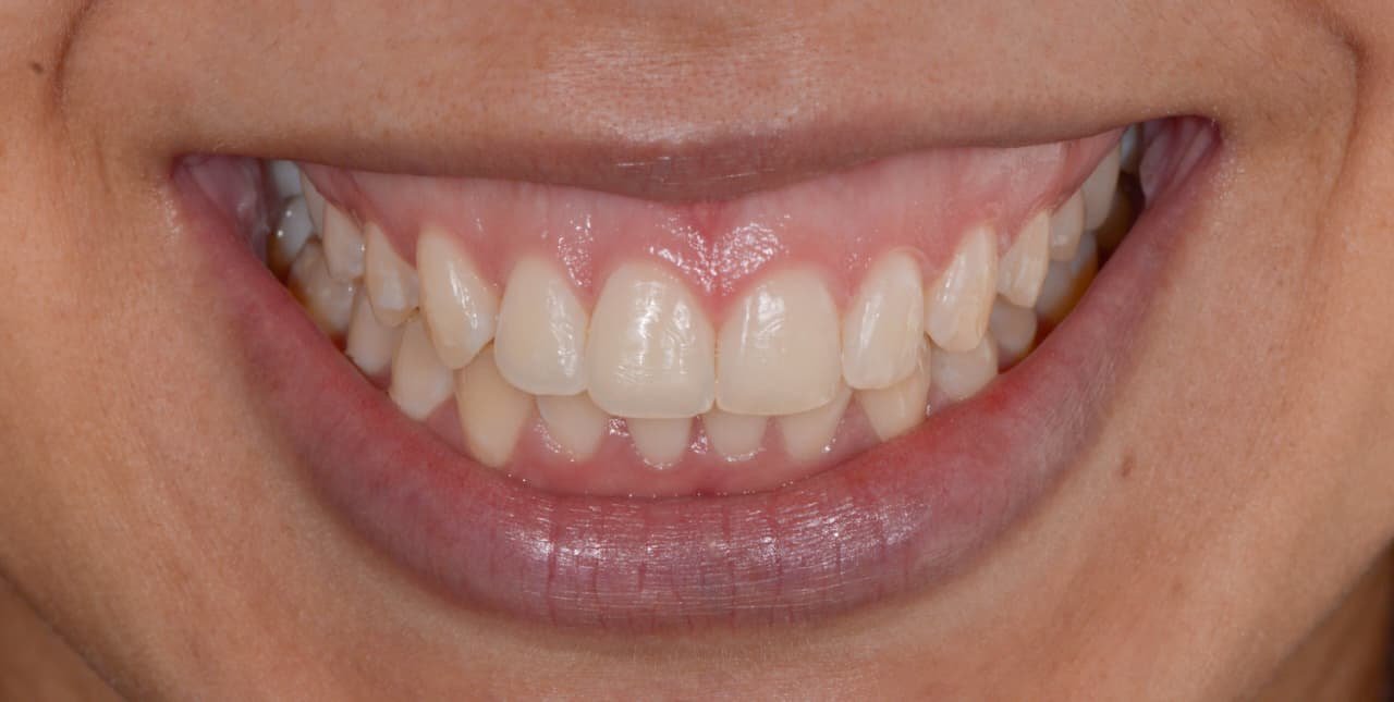 Tratamento periodontal