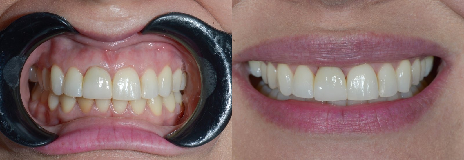 Antes e depois de implante dentário, caso 1