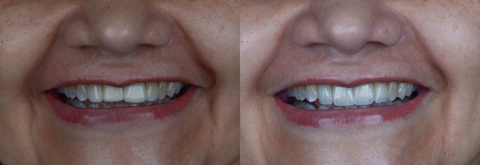 Antes e depois de implante dentário, caso 2
