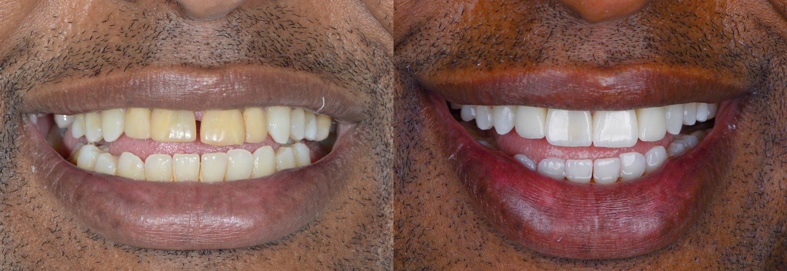 Antes e depois de implante dentário, caso 4