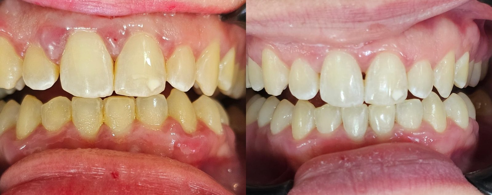 Antes e depois de tratamento periodontal, caso 2