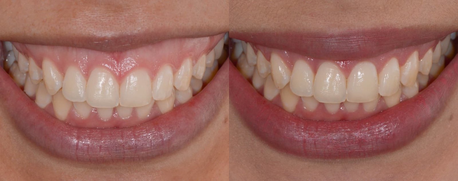 Antes e depois de tratamento periodontal, caso 4