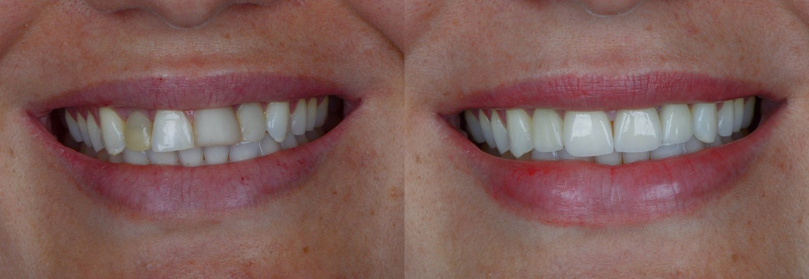 Antes e depois de reabilitação oral, caso 1