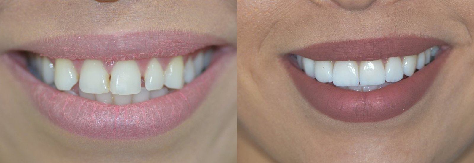 Antes e depois de reabilitação oral, caso 2