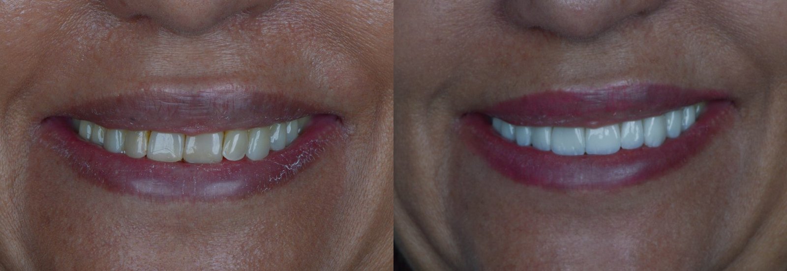 Antes e depois de reabilitação oral, caso 3